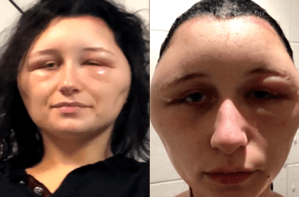 Teen suffers massive swollen head after allergic reaction to hair dye